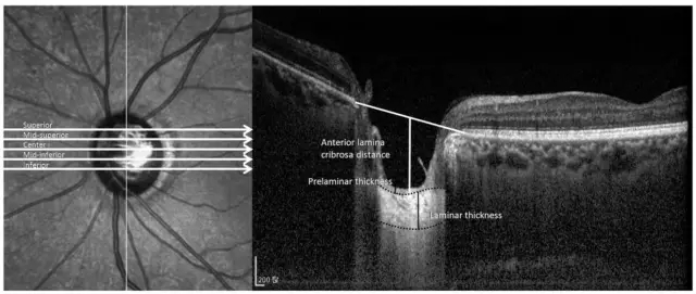 青光眼进展是通过视盘,视网膜神经纤维层(rnfl)照相或视野检查进行